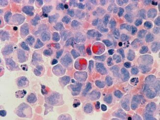 18 pacientes, todos curados: la prometedora pastilla experimental contra la leucemia más agresiva
